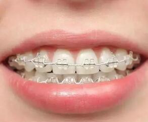 石家庄美莱医疗美容机构靠谱吗 牙齿矫正要先拔牙