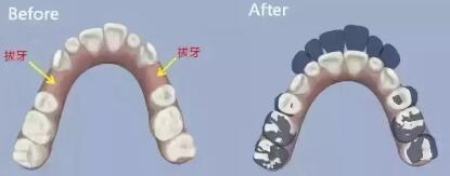 石家庄美莱医疗美容机构靠谱吗 牙齿矫正要先拔牙