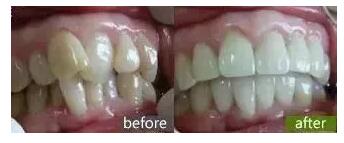 石家庄美莱医疗美容机构靠谱吗 牙齿矫正要先拔牙