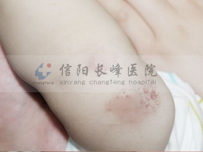 信阳长峰血管瘤医院为您讲述婴幼儿血管瘤疾病的症状表现!