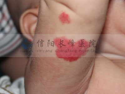 信阳长峰血管瘤医院为您讲述婴幼儿血管瘤疾病的症状表现!