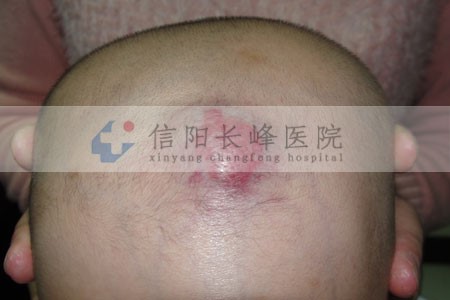 对于混合型血管瘤疾病的危害您了解过没有?信阳长峰血管瘤医院带您了解