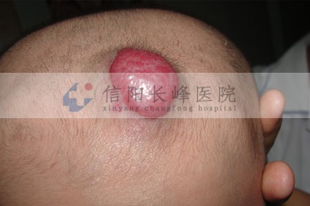 对于混合型血管瘤疾病的危害您了解过没有?信阳长峰血管瘤医院带您了解