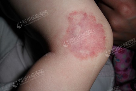 婴幼儿血管瘤在饮食上都是有哪些禁忌你知道吗?郑州长峰血管瘤医院给您答案