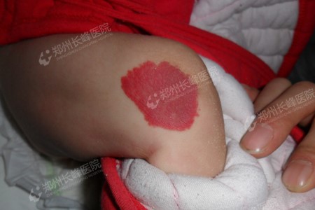 婴幼儿血管瘤在饮食上都是有哪些禁忌你知道吗?郑州长峰血管瘤医院给您答案