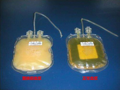 Ѫ֬߶ϲ淥͡ƬΪʲô