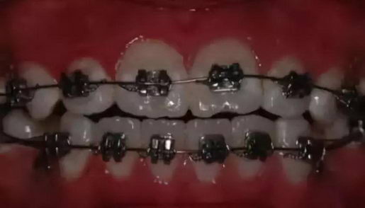 戴牙套要多少钱?新安口腔隐形矫正立减4000元