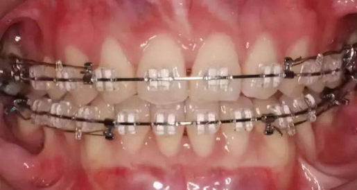 戴牙套要多少钱?新安口腔隐形矫正立减4000元