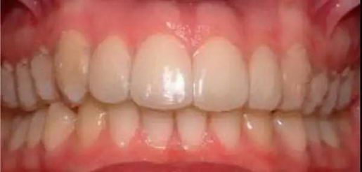 戴牙套要多少钱?新安口腔隐形矫正立减4000元