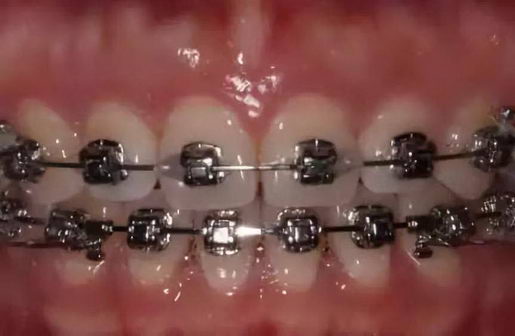 戴牙套要多少钱?新安口腔隐形矫正立减4000元