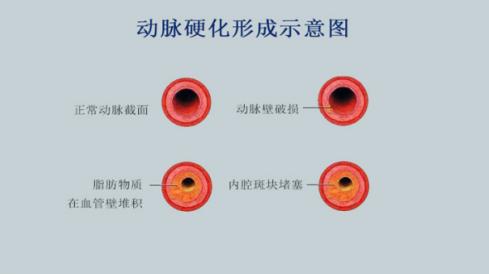 高血脂吃什么药?一边倒的瑞舒伐他汀钙片到底好用吗?