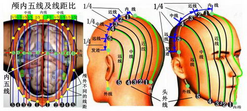 陈氏五线针刺法创始人——陈序选