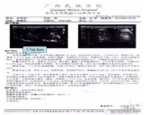 曾冰医师 解决治疗乙肝 肝癌的技术难题
