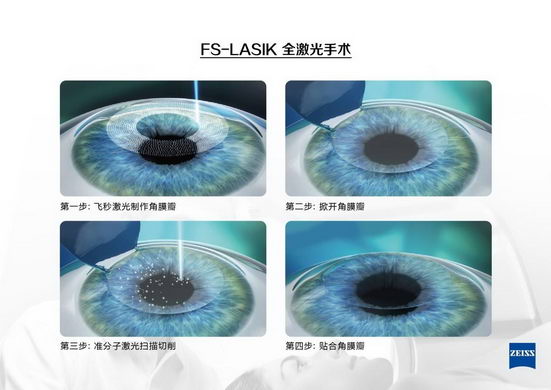 沈阳普瑞眼科近视手术怎么样 近视手术哪种最好