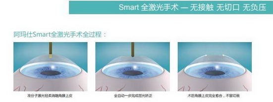 沈阳普瑞眼科近视手术怎么样 近视手术哪种最好