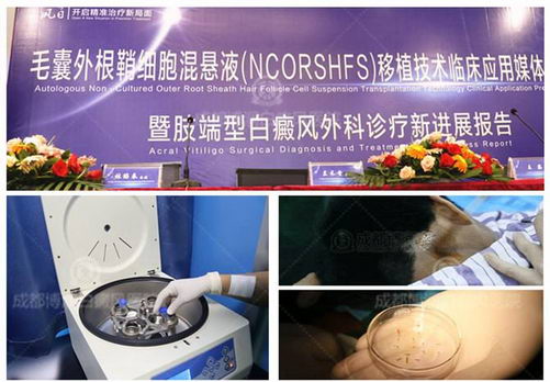 成都博润白癜风精准医学项目,毛囊外根鞘外科治疗