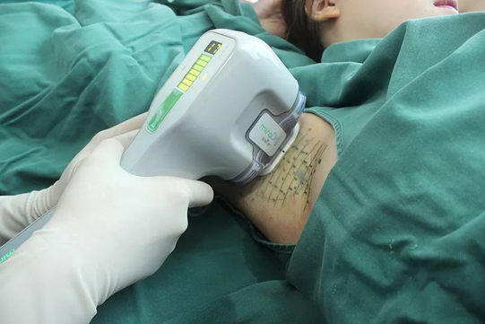 ŮУ԰׹¥miradry΢ഺûҸ