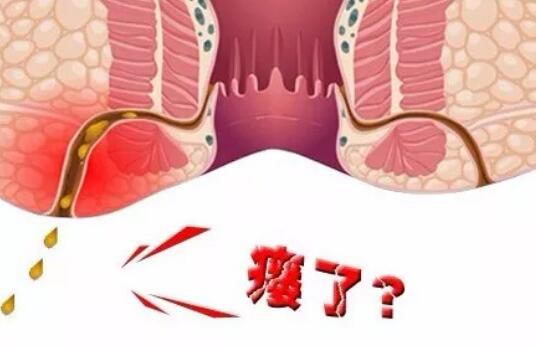 无锡东方肛肠医院 肛门周围的小脓包怎么会变成肛瘘呢?
