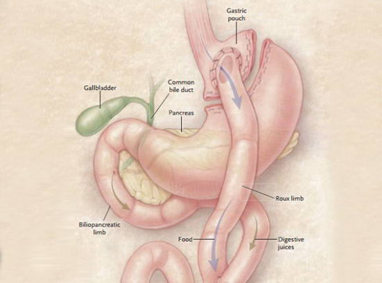 旁路手术可以治疗糖尿病是真的吗?