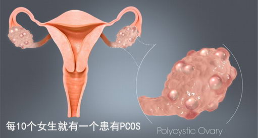妇科专家如何看待多囊卵巢综合征