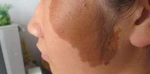 公益行,在路上,脸博士胎记公益行助胎记患者获得健康