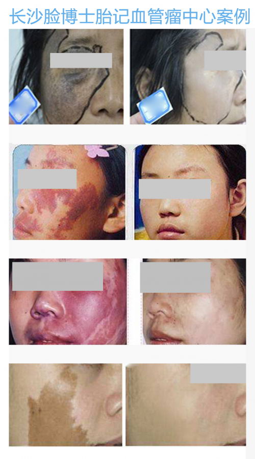 公益行,在路上,脸博士胎记公益行助胎记患者获得健康