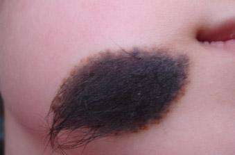 公益行,在路上,脸博士胎记公益行助胎记患者获得健康