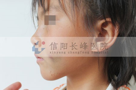 河南信阳治疗海绵状血管瘤怎么样?