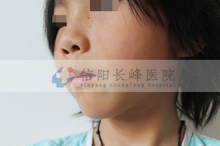 河南信阳治疗海绵状血管瘤怎么样?