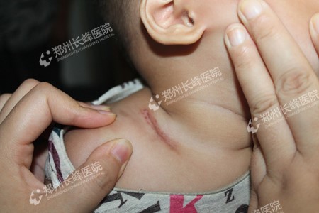 河南郑州治疗血管瘤效果好不好?