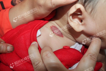 河南郑州治疗血管瘤效果好不好?