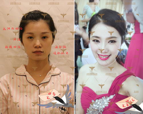 自体多肽脂肪填充面部后,抗衰效果竟然如此有效?