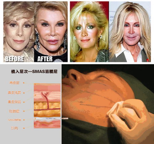 拉皮除皱陷阱多,如何选择?爱尔丽金丝拉皮黄金奈米化爱美0风险