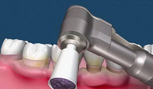 什么是洗牙?“口腔健康1+1”和洗牙有什么关系?