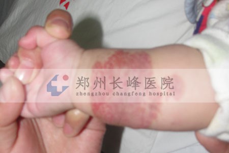 郑州治疗混合型血管瘤效果好不好?