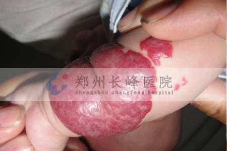 郑州治疗混合型血管瘤效果好不好?