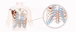 隆鼻不要盲目,适合自己才是关键!贵美汇靳玉彪主任自体肋软骨隆鼻案例