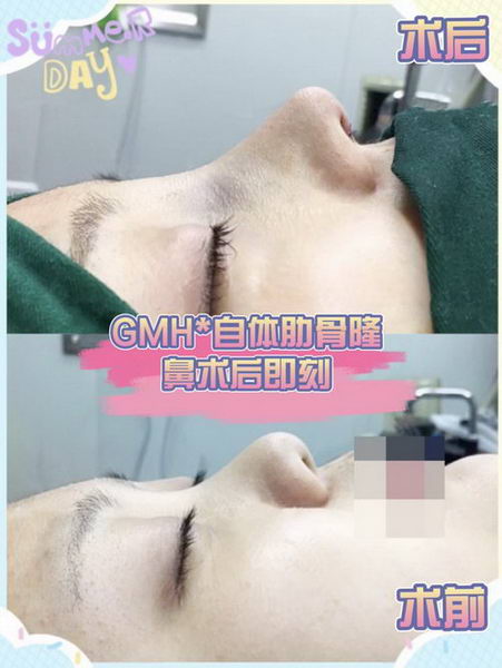 隆鼻不要盲目,适合自己才是关键!贵美汇靳玉彪主任自体肋软骨隆鼻案例