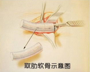 隆鼻不要盲目,适合自己才是关键!贵美汇靳玉彪主任自体肋软骨隆鼻案例