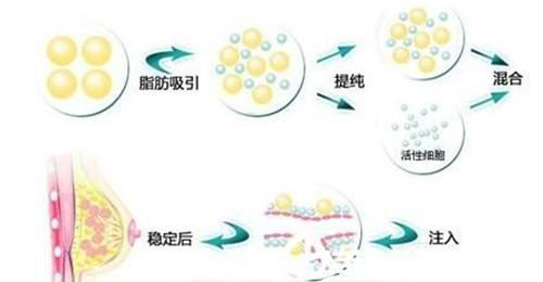 韩啸医生解析自体脂肪移植成活率有多高?