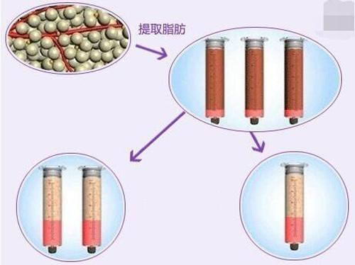 韩啸医生解析自体脂肪移植成活率有多高?