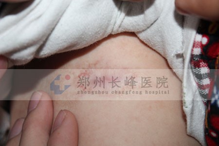 南阳的医院能不能治疗孩子身上的草莓状血管瘤?