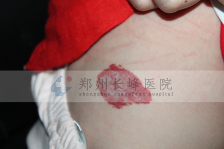 南阳的医院能不能治疗孩子身上的草莓状血管瘤?