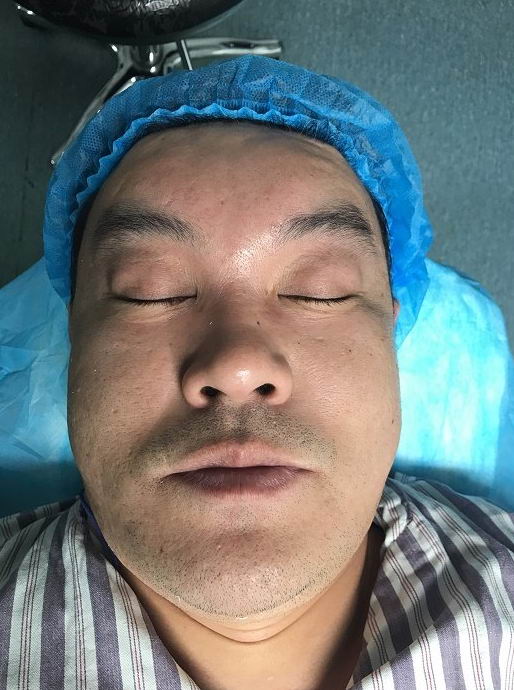 李方奇分析:硅油取出开刀切除和微创取出哪种更好?