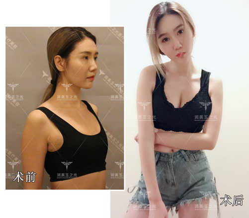 张红芳博士解读:为什么CGF自体框架脂肪丰胸丰臀不下垂?