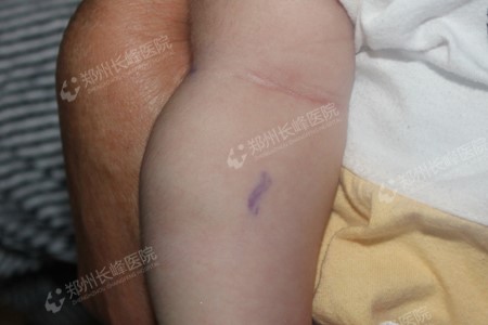 河南郑州能治疗孩子胳膊上的血管瘤吗?