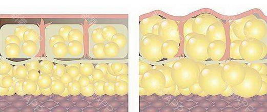 自体脂肪丰胸后为什么会忽大忽小?韦元强分析
