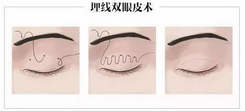 丽星翼美双眼皮修复怎么样?都有哪些手术术式
