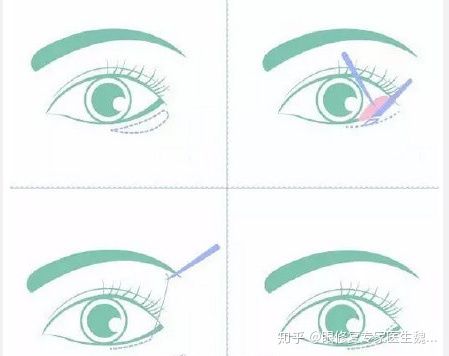 丽星翼美双眼皮修复怎么样?都有哪些手术术式