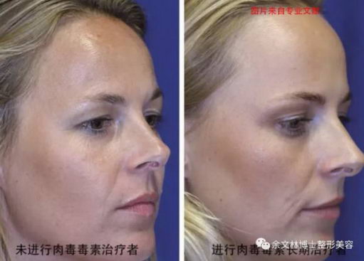 余文林|注射除皱针的副作用有哪些?